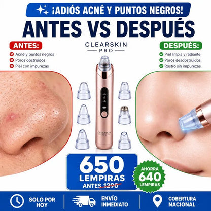ClearSkin Pro™ – Limpiador Facial de Puntos Negros con Succión Eléctrica